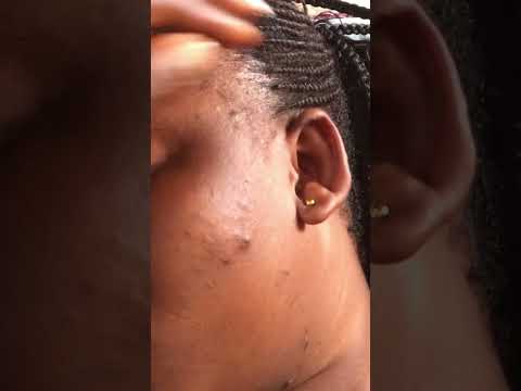 SUPER ATTENTIVE DEEP EAR NITPICKING FOR THOSE WHO WANT TO SLEEP #tingly #asmr #facial #nitpicking