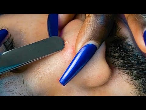 {ASMR} Nurse Nitpicking & EXTRACTING Face WHITEHEADS & INGROWNS | Eyebrow Scratching | ALLZOOMED