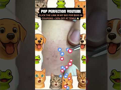 Wow! #pimpleremoval #pimple #pimples #shortsfeed #shortvideo #shorts #short #youtube #youtubeshorts
