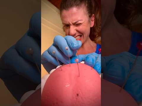 ASMR acupuntura na lingua