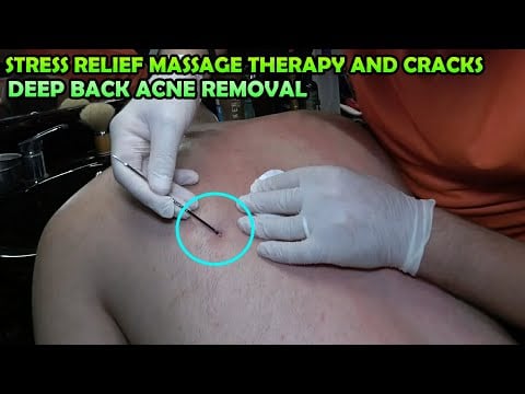 ASMR BARBER DEEP BACK ACNE REMOVAL AND MASSAGE 💈 CRACKS 💈 STRESS RELIEF UPPER BODY MASSAGE FOR YOU