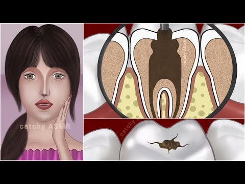 Dental decay restoration animation || Teeth cleaning ASMR animation ||