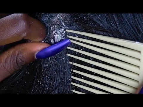{ASMR} Scalp Scratching & NITPICKING dried flakes | ALLZOOMED | no talking