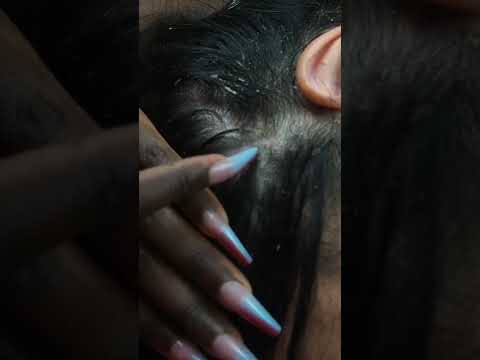 Dandruff scratching & removal #asmr #relax #fyp #foryoupage #viral #explorepage #nails #hair
