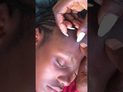 Face Nitpicking Asmr #satisfying #asmrscratching #asmr #skincare