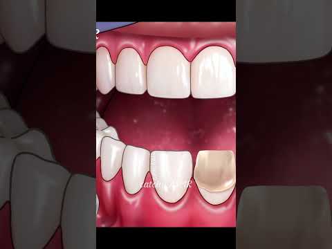 Dental treatment animation, Rotten teeth repair , ASMR animation, relaxing cavity filling treatment,