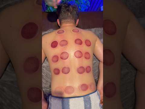 Cupping Therapy: Unlock the Power of Deep Healing#shorts #viral #fyp #trending #trendingshorts