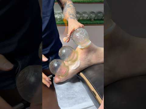 wow ASMR Hot Cupping#cupping #viral #shorts #asmr #cuppingtherapy #fyp