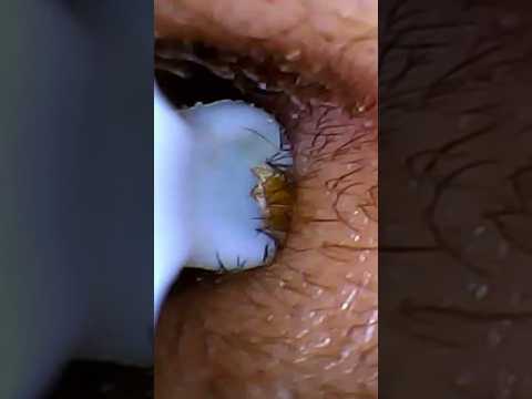 Ear Deep Cleaning Camera Viewing Tool ASMR