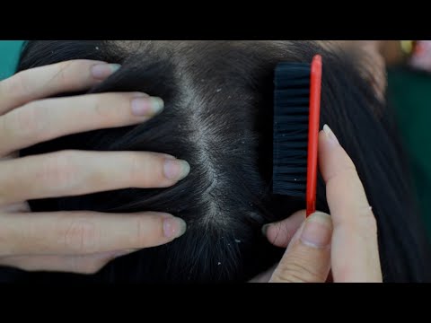 ASMR Dandruff Scratching On Real Person For Itchy Relieve ( Scalp Check, Scalp Scratching )