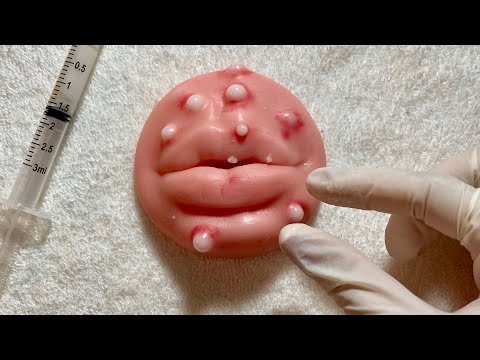 ASMR- REMOVENDO ESPINHAS E TRATAMENTO DE ACNES (DURMA AQUI)