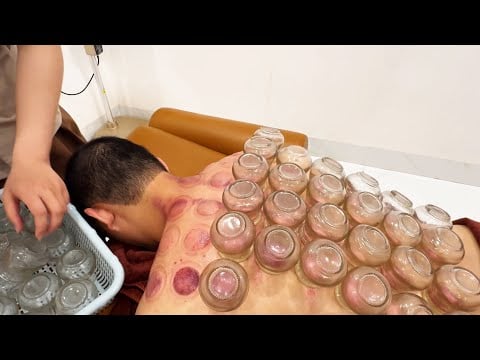 ASMR 🇻🇳 Traditional Fire Cupping & Gua Sha Therapy | Deep Muscle Detox & Relaxation