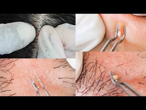 Super-zoomed Face Extractions & Picking Ingrown Hair | Scalp Nitpicking Whiteheads 💆🏼‍♂️| ASMR