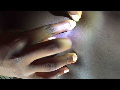 Asmr ~ Most Satisfying Back Nitpicking | It’s Time For Sleep #asmr #nitpicking #acne