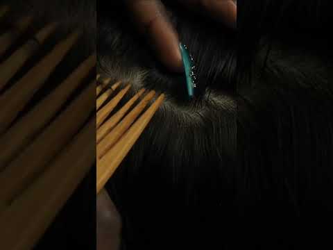The Most Satisfying NITPICKING WHITEHEADS from my husband scalp #shorts #shortsvideo #short