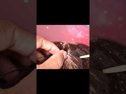 ASMR POV - Tirando caspa do seu cabelo #asmr #pov #caspa #shortsvideo #asmrshorts #cabelo