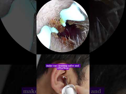 💤 Oddly Satisfying Ear Cleaning ASMR Using Bebird Earsight Plus #earcleaning #asmr #earwax