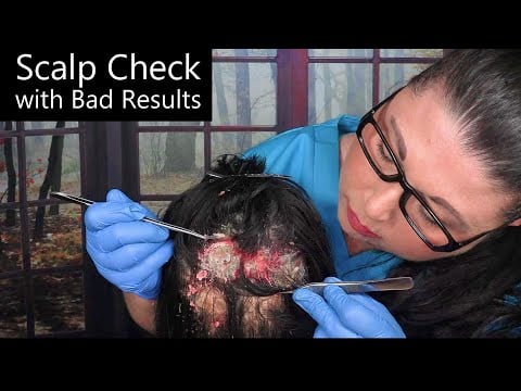 ASMR Scalp Check with Bad Results (Dry Skin Removal, Dandruff Removal, Scalp Treatment) Medical RP