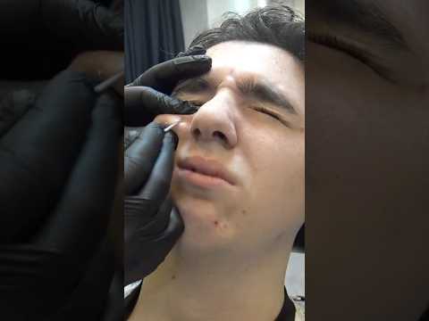 ACNE & BLACKHEADS REMOVAL - TICKLISH MASSAGE #haircut #shorts #asmr #massage #cracks #barberskincare