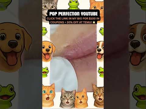 Wow! #pimpleremoval #pimple #pimples #shortsfeed #shortvideo #shorts #short #youtube #youtubeshorts