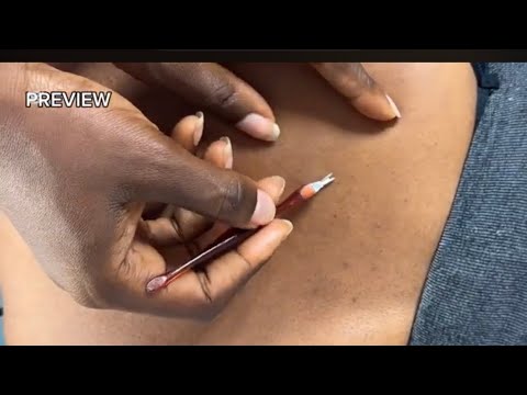 ASMR SATISFYING DEEP EAR NITPICKING CLEANING MASSAGE AND SCALP SCRATCH, BACK SCRATCHING