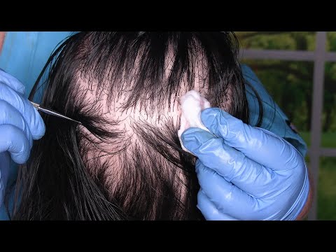 ASMR Scalp Check and Treatment (Lice Check, Scalp Scratching, Close Up, Whispering) Medical Roleplay