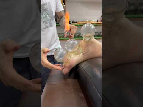Have you ever experienced it?#shorts #cupping #asmr #explore