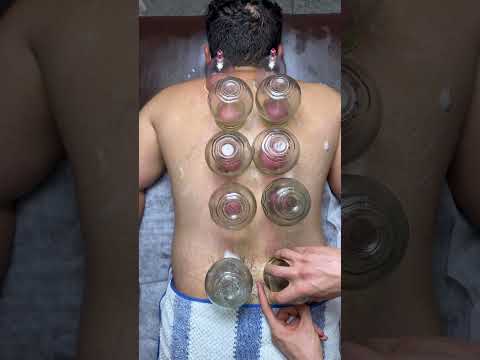 pizaa cupping😍🍕#cupping #cuppingtherapy #shorts #viral