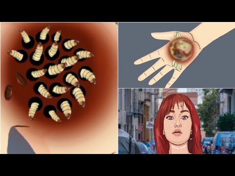treatment of maggots wound infected hand animated ASMR || treatment removal of maggots ASMR