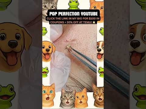 Wow! #pimpleremoval #pimple #pimples #shortsfeed #shortvideo #shorts #short #youtube #youtubeshorts