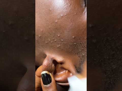 Asmr deep ear cleaning/ very satisfying #asmr #tinglyfeeling #earcleaning