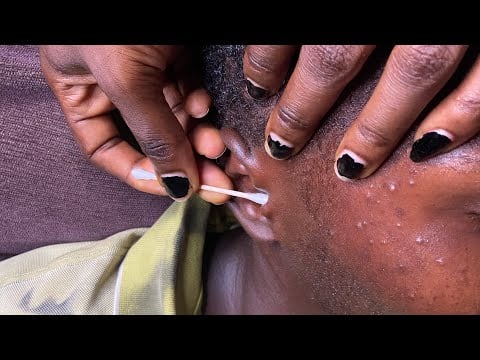 Asmr Dirty Ear Deep Cleaning- For Those Who Can’t Sleep.