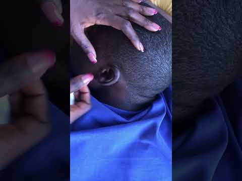 Asmr pimple Popping #asmrsounds #satisfying #relaxing #headscratches #blackheads