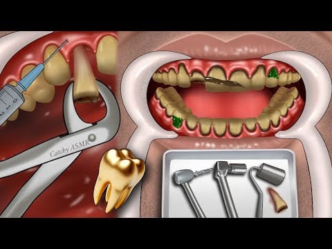 ASMR damage tooth extraction|| gold teeth implant|| dental decay treatment animation||ASMR animation