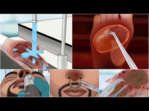 Treatment animation collection|| Chemical burn treatment|| Fire burn treatment|| ASMR animation||