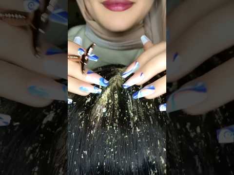 Dandruff Removal 😱💆🏻‍♀️ #asmr #satisfying #visualtingle #relaxing #mouthwhisper #relax #shorts