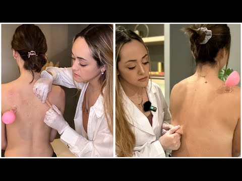 ASMR Back Exam [Skin Cracking, Skin Pulling, Measuring] Compilation | 'Unintentional' Roleplay