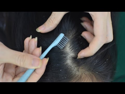 ASMR Head Massage No Talking, Hair Parting, Hair Brushing On Real Person For Headache Relief