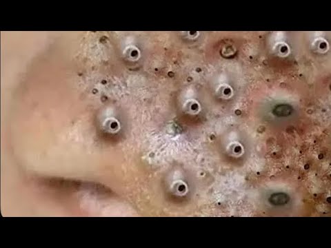 SATISFYING AND RELAXING PIMPLE POP COMPILATION | PART 20