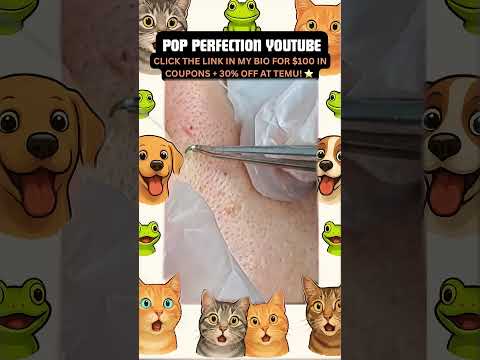 Wow! #pimpleremoval #pimple #pimples #shortsfeed #shortvideo #shorts #short #youtube #youtubeshorts