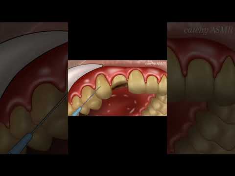 Tooth extraction animation||dental implant surgery||#treatmentanimation #animation #asmrvideo #asmr