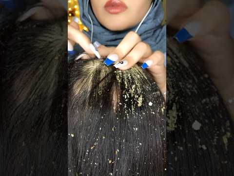 Dandruff Removal 💆🏻‍♀️ #asmr #satisfying #visualtingle #asmrmassage #tingles #relaxing #shorts
