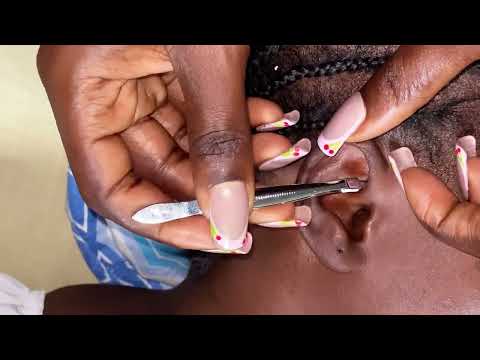 ASMR EAR CLEANING WITH ALOT OF TINGLES- Bubble gum Cracking