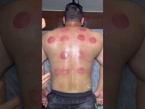 asmr cupping😍#shorts #asmr #cupping