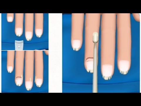 Hand-nails cleaning ASMR|| ingrown nail animation