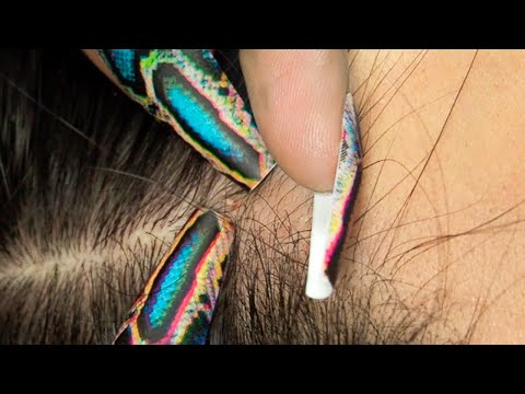 ASMR Attentive & Tingly Nitpicking Whiteheads ~ Soft whispers ☁️