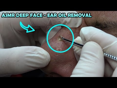 ASMR BARBER FACE AND NOSE OIL REMOVAL + SKIN CARE + EAR WAX + EAR BURN + ASMR DEEP TOUCH THERAPY
