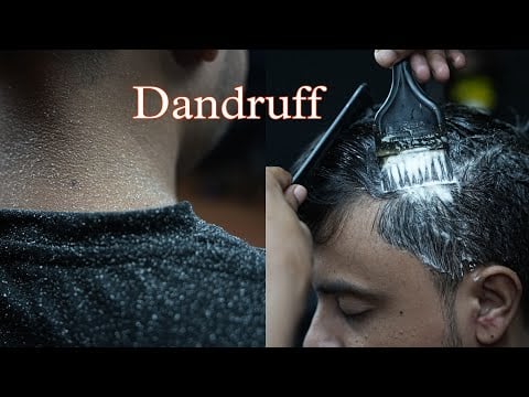 Satisfying Dandruff Removal ASMR | Dandruff Treatment ASMR | Satisfying Dandruff Scratching ASMR