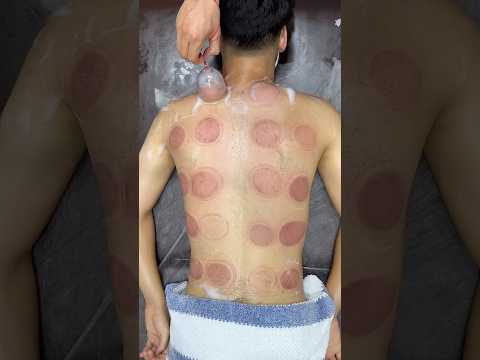 wow cupping😍#asmr #massage #explore #cupping #youtubeshorts #trending #trendingshorts #fyp #fire