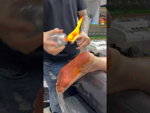 I promise you've never seen cupping like this before#cupping #shorts #viral #trending